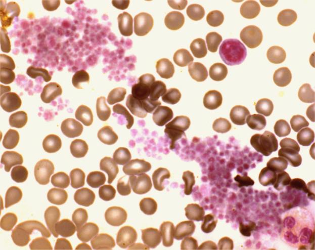 Iden:fica:on of EDTA- induced pseudothrombocytopenia