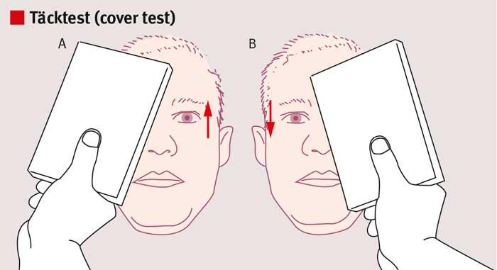 Valutazione HINTS Test di Skew L esaminatore copre alternativamente gli occhi del paziente; la comparsa di un saccade di re-fissazione