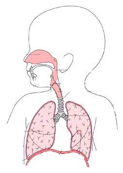 GENOGRUPPO 4 E SEVERITA DELLA MALATTIA RESPIRATORIA POLMONITE ALTRE MALATTIE (laringiti, bronchiti,