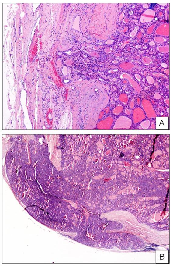 l'esame istologico definitivo, effettuato sul nodulo tiroideo dopo l'asportazione chirurgica. Il carcinoma follicolare presenta una diffusione metastatica generalmente per via ematogena.