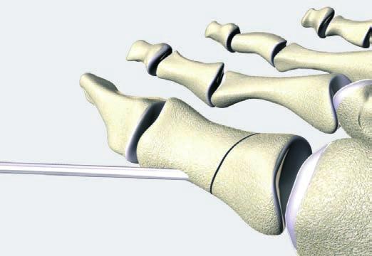 Tecnica chirurgica placca a 2 fori Fissazione di un osteotomia di Akin Non è descritto alcun piano preoperatorio. 1 Osteotomia Viene eseguita un incisione mediale. Effettuare l osteotomia.