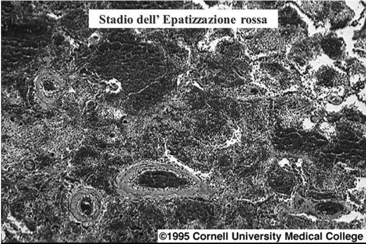 Quadro anatomo-patologico Epatizzazione rossa (dopo alcuni giorni): aumento dei neutrofili, della fibrina che riempie l alveolo e dà