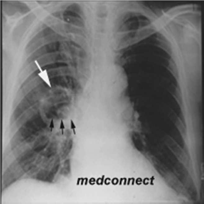 Carcinoma Epidermoide o