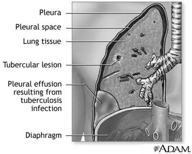 Pleuriti p. parapneumonica (decorre durante p.broncopolmonare) a) Pleuriti infettive Batteriche p. Metapneumonica (decorre dopo la p.