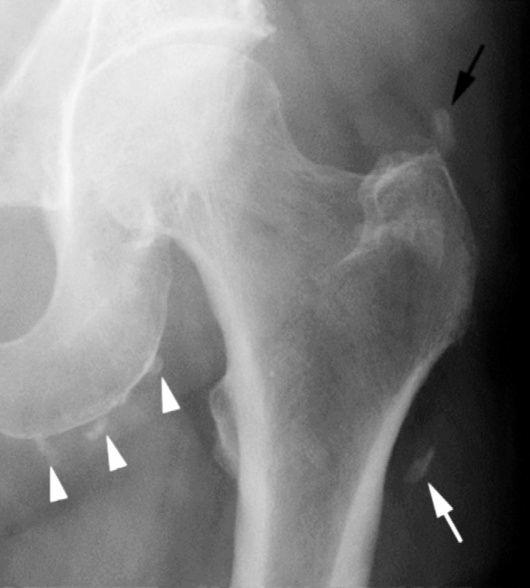 Malattia da deposito di idrossiapatite: Rx Multiple calcifcazioni adiacenti al grande