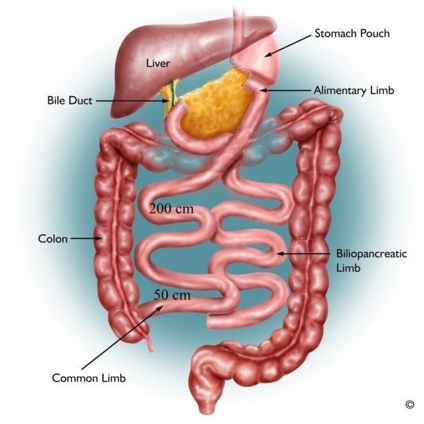 DIVERSIONE BILIO-PANCREATICA Vantaggi: Calo significativo (>70% del sovrappeso) e mantenimento a distanza del peso perduto. Possibile esecuzione in laparoscopia.