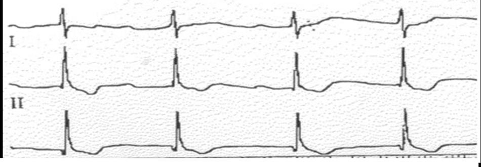 La donna aveva raccolto involontariamente delle foglie di una giovane pianta di digitale (Digitalis purpurea) contenente glicosidi cardioattivi (come la digossina) e, di conseguenza, la sua