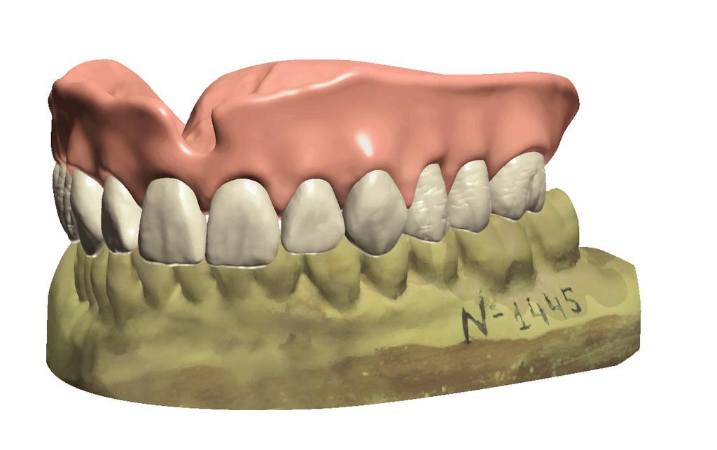 Eseguite protesi totali digitalmente La combinazione del più recente software Denture Design di 3Shape con le nuove possibilità di produzione rendono la produzione digitale di protesi molto