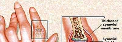 and cartilage in several joints Elevated levels of pro-inflammatory cytokines TNF-α, IL-1,