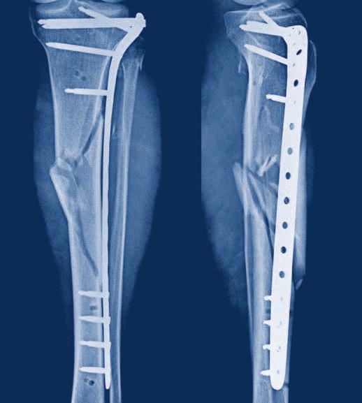 Indicazioni La LCP PLT è indicata per la stabilizzazione di fratture della tibia prossimale.