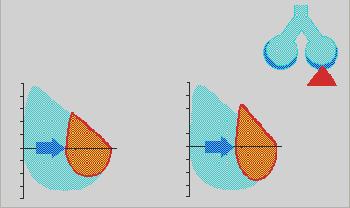 Le curve dei pazienti con una malattia respiratoria restrittiva hanno una forma