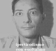 LAGOFTALMO Consiste nell impossibilità di chiusura delle palpebre. Può essere dovuto ad una lesione periferice dal faciale che determina la paralisi dell orbicolare (l.