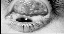 del lfilm lacrimale è in genere poco marcato, in contrasto con il notevole disturbo soggettivo lamentato dal paziente.