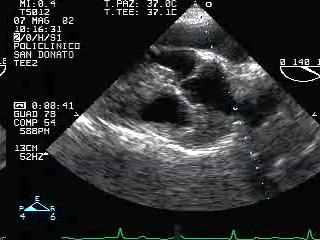 Left Ventricular