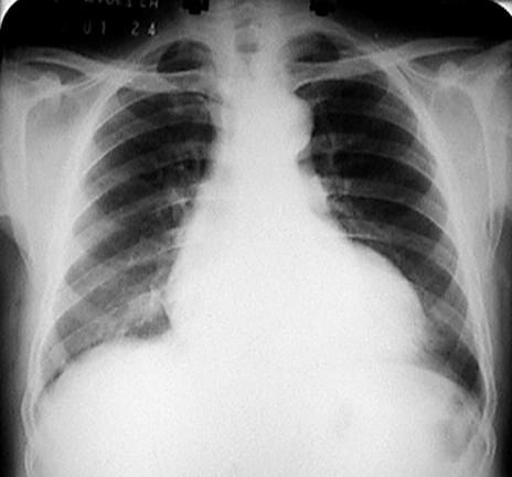 L insufficienza cardiaca: fisiopatologia Processi patologici Disfunzione Ventricolare Sistema Simpatico Aumentata contrattilità Tachicardia Aumentato