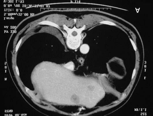 stage epatectomia destra (pezzo operatorio) Figura 5A e 5B. F.S.