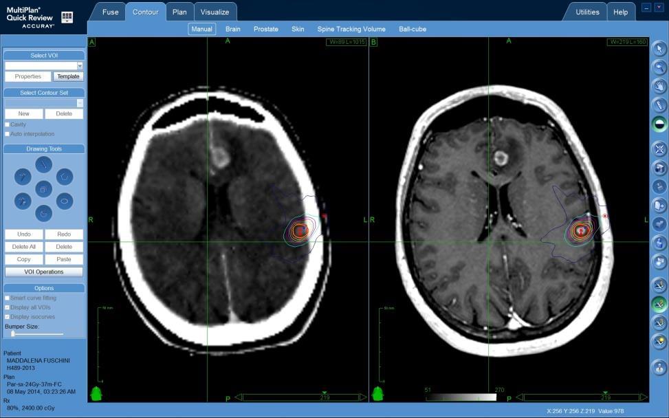 12/05/2014 Esegue trattamento radiochirurgico a livello della lesione cortico-sottocorticale destra.