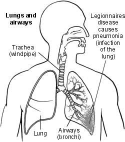Malattia dei Legionari: polmonite con consolidamento multilobulare, infiammazione e microascessi.