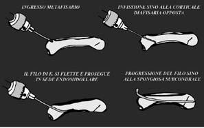 La stessa metodica è stata estesa al trattamento delle fratture diafisarie sia trasversali che oblique corte, con eccezione di quelle con instabilità rotazionale e di quelle composte.