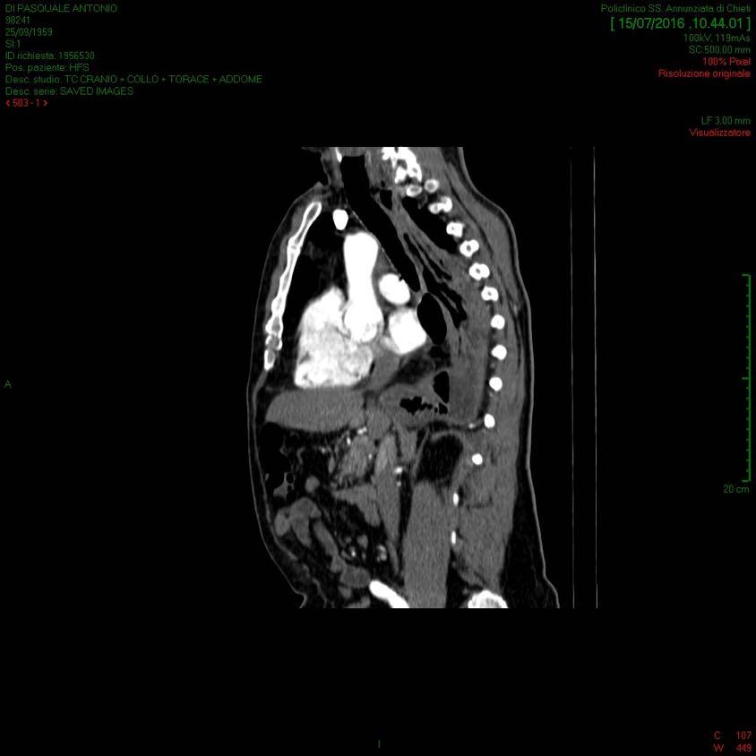 Parete esofagea con erosione mucosa, iperparacheratosi e iperplasia del compartimento proliferativo dell epitelio pavimentoso e con flogosi linfomonocitaria e sclerosi