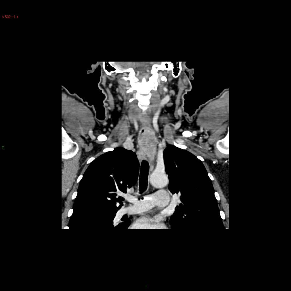 estensione longitudinale 5 cm) prevalentemente cervicale