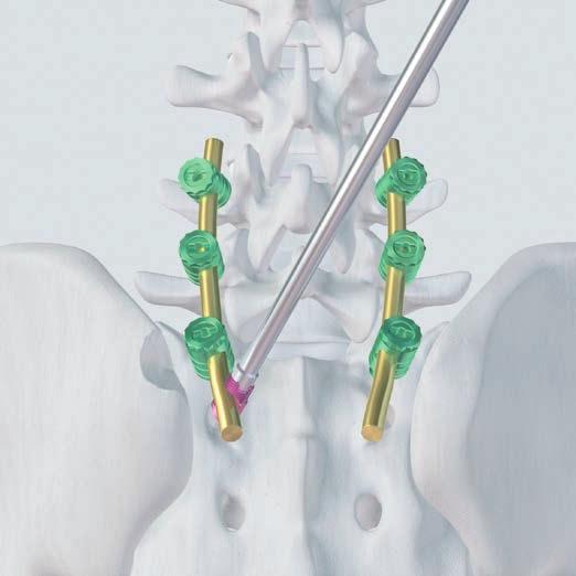 fissaggio. Nota: il supporto per dispositivo di fissaggio ha all incirca una lunghezza doppia di quella del supporto per viti USS II Polyaxial.