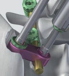 0 mm, con impugnatura a T 1 2 Prelevare un dado usando la chiave a tubo con impugnatura dritta (nera), metterlo sopra la calotta della vite iliaca e serrare leggermente.