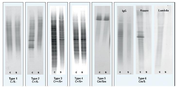 Tipo 1: Normale Elettroforesi proteica Tipo 4 («Mirror Tipo 3: Le bande Tipo 6: Pattern Tipo 2: Le IgG Pattern»): Le B.O.