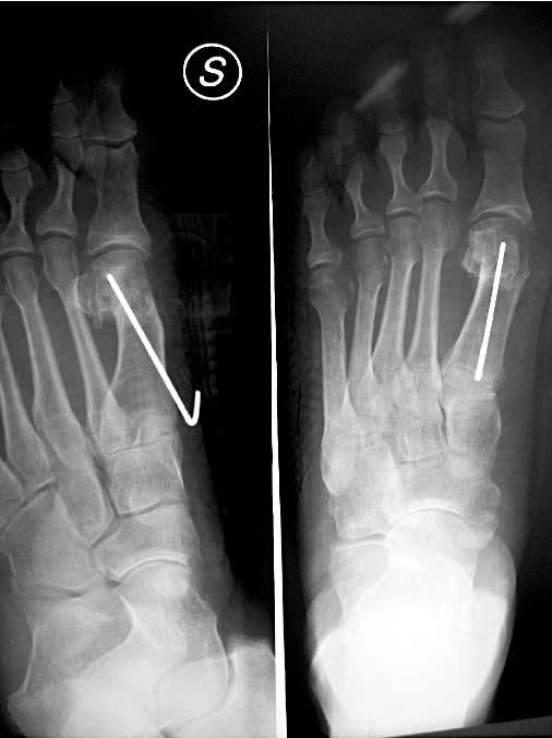 La fissazione nelle osteotomie di correzione dell alluce valgo Fig. 1. Paziente di sesso femminile operata per alluce valgo a sinistra mediante osteotomia chevron e sintesi con filo di Kirschner.