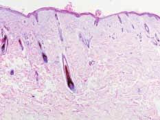 Follicolite murale dell interfaccia con degenerazione idropica e infiltrato di linfociti e neutrofili nella zona istmica (E-E, medio ingrandimento).