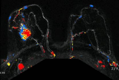 Breast Cancer : stadio II - III Chemioterapia Neo-Adjuvante