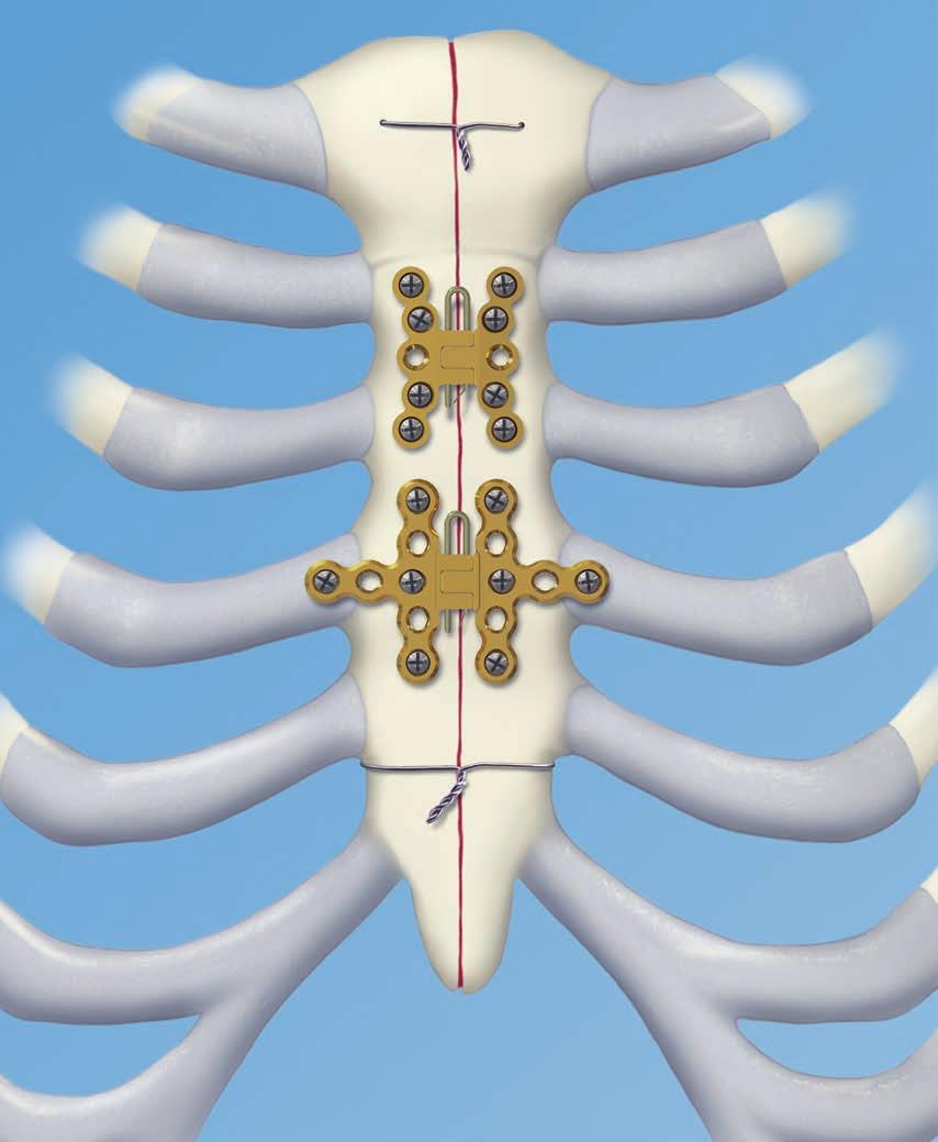 Sistema di fissazione dello sterno in titanio.