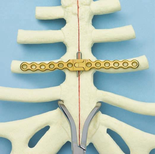 9 Posizionamento della placca Posizionare la placca in modo da consentire il posizionamento di almeno quat tro viti su ogni lato della linea di frattura/dell osteotomia.