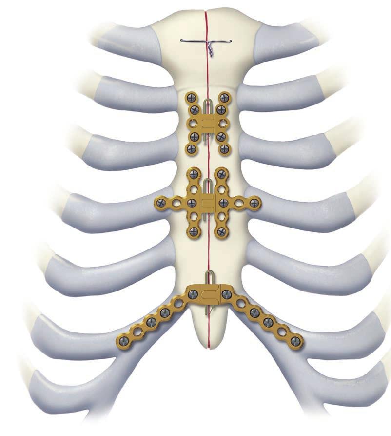 Sistema di fissazione dello sterno in titanio. Fissazione interna stabile dello sterno.