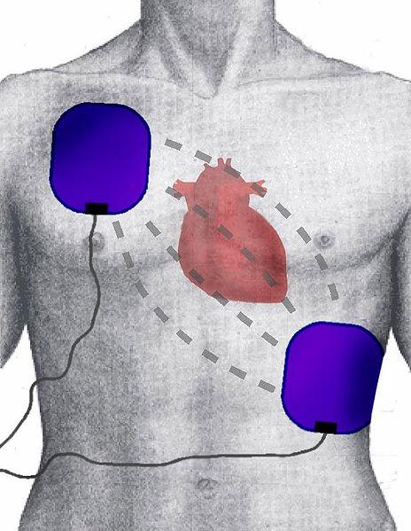 Defibrillatore Una scarica elettrica puo interferire con