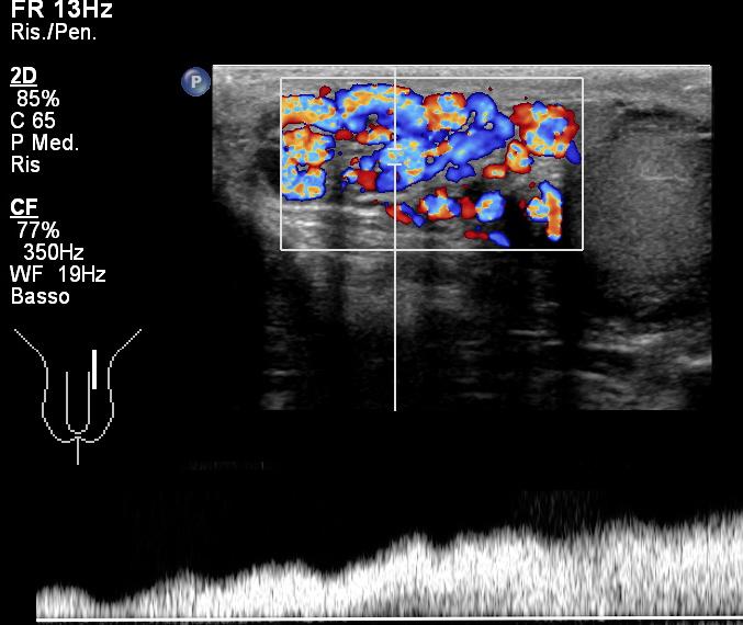 Si procede quindi allo studio e alla descrizione del plesso pampiniforme (Figura 3), e in presenza di ectasie venose deve esserne riportata: - la localizzazione (funicolare, sovratesticolare,
