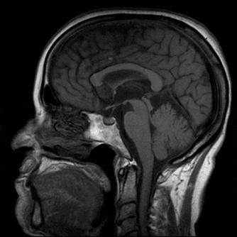 DEGENERAZIONE CEREBELLARE PARANEOPLATCICA CLINICA insorgenza subacuta di Deambulazione Atassica Altri segni e sintomi di disfunzione cerebellare + Marcato calo ponderale LIQUOR 50%