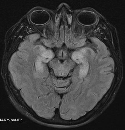 ENCEFALITE LIMBICA CLINICA insorgenza subacuta di Deficit mnesici /decadimento cognitivo Crisi epilettiche Sintomi psichiatrici