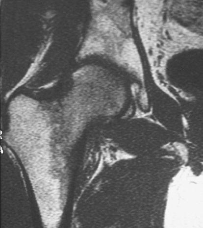 OSTEOPOROSI TRANSITORIA: RM CORONALE T1 T2