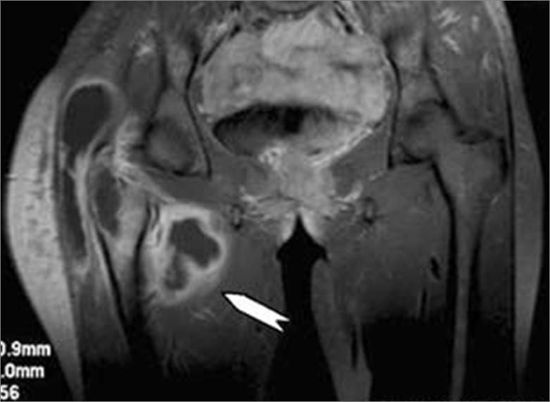 Artrite tubercolare: RM