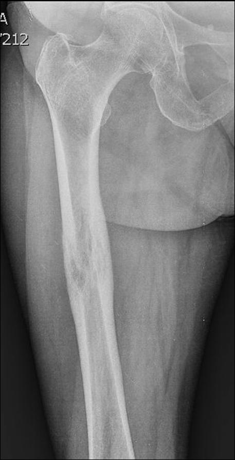 LINFOMA: Rx Area di osteolisi