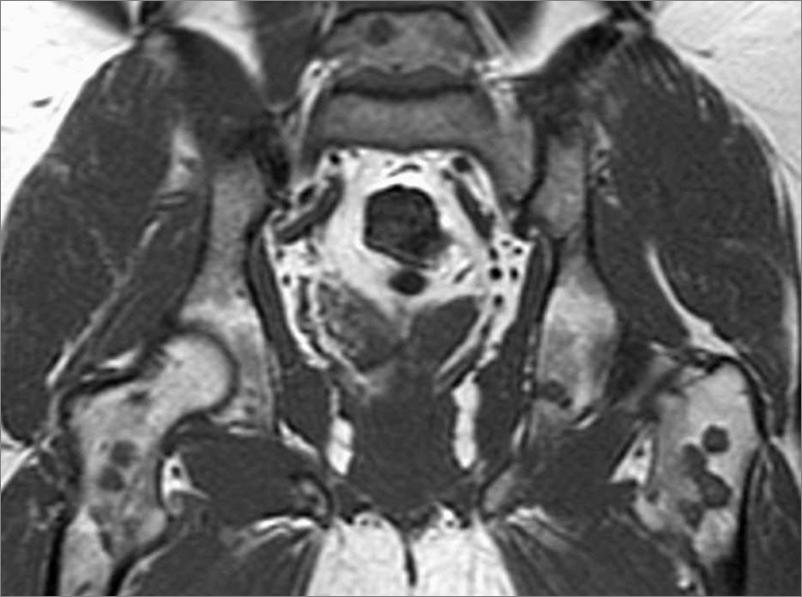 osteolitico (ipointense in T1 ed