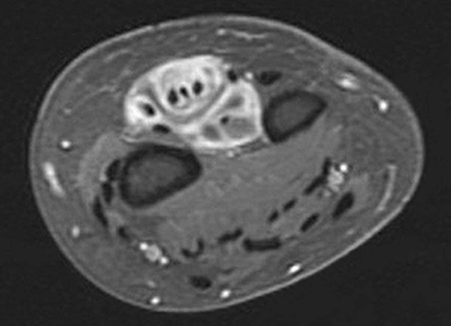 SARCOIDOSI: RM Il quadro di coinvolgimento articolare (tenosinoviti,