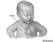 sinistra al II spazio Sdoppiamento e Riduzione del II tono Sintomi: Presentazione Clinica Le forme Lievi-moderate sono per lo più asintomatiche Indagini di ausilio nella diagnosi possono essere: Le