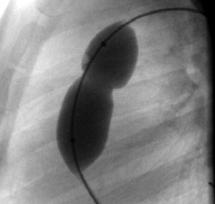 ECG; gradiente transvalvolare