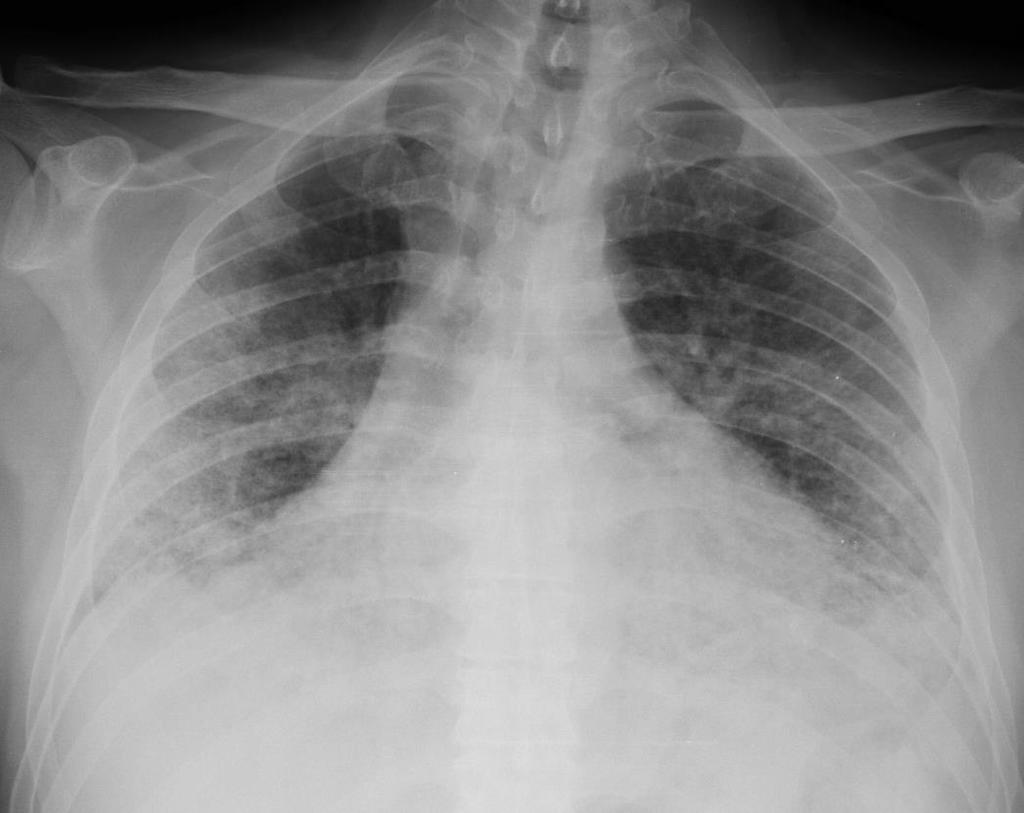 diffuse opacità a contorni