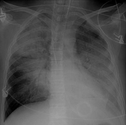 Opacità Parenchima polmonare opacità alveolari focali o diffuse