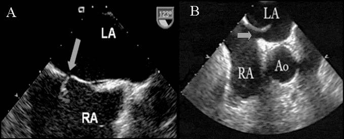 A Carcagnì, G Di Sciascio - L ecocardiografia nel forame ovale pervio pervietà del forame ovale, la chiusura percutanea del FOP è ormai un trattamento diffuso nella pratica clinica.