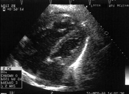 Capitolo 1 La stenosi valvolare aortica critica neonatale Figura 1.