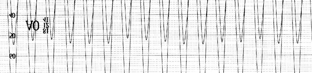 ell arteria carotid e e su tu rata l arteriotom